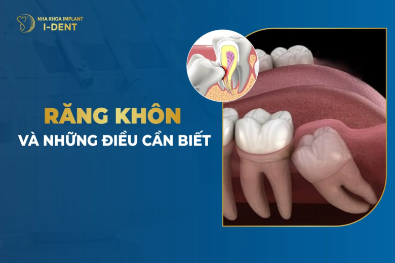 Răng Khôn Và Những Điều Cần Biết