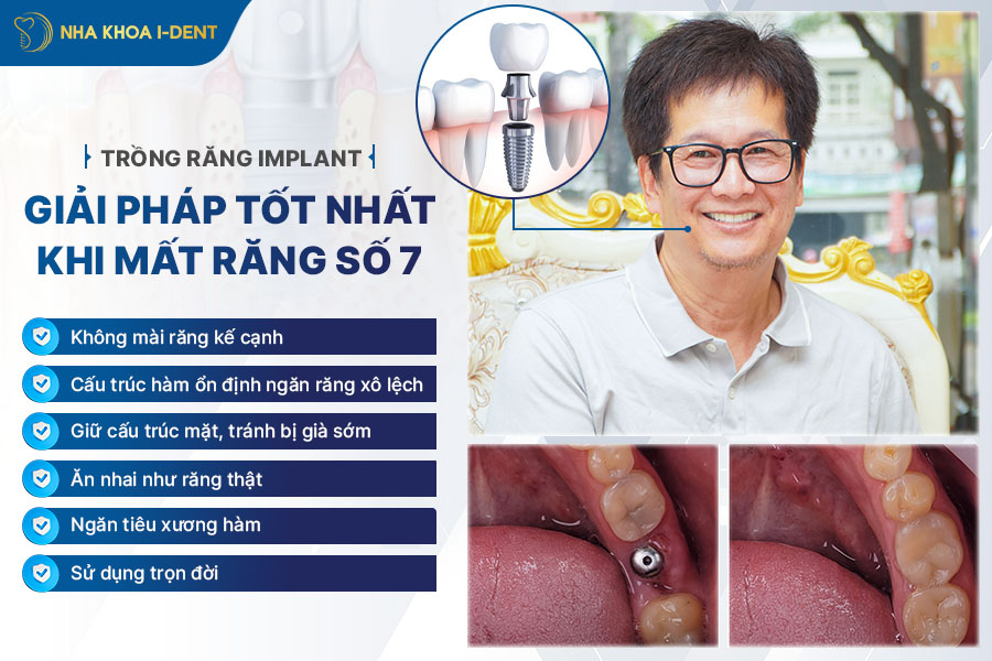 trồng răng số 7