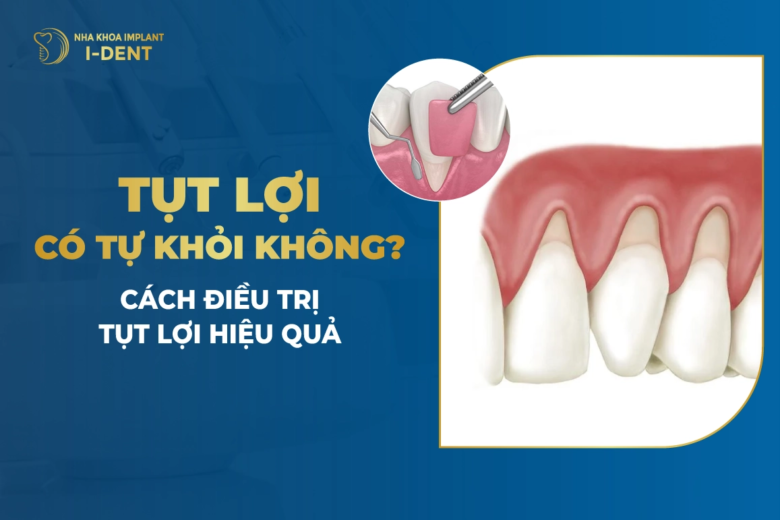 Tụt Lợi Có Tự Khỏi Không? Cách Điều Trị Tụt Lợi Hiệu Quả