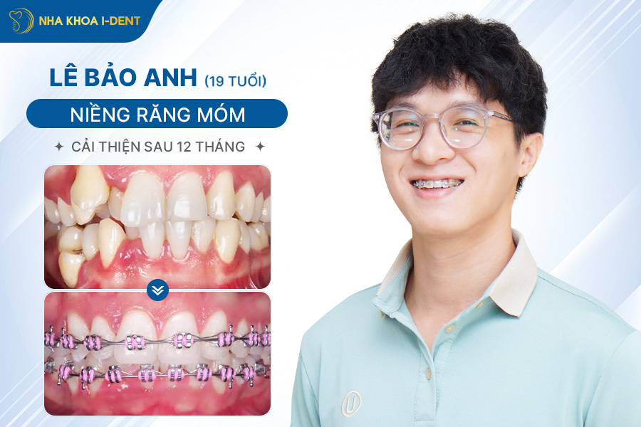 nieng rang mom - Nha khoa I-Dent