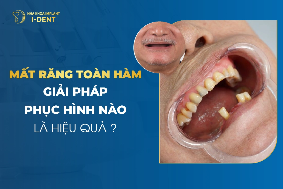 Mất Răng Toàn Hàm: Giải Pháp Phục Hình Nào Là Hiệu Quả?