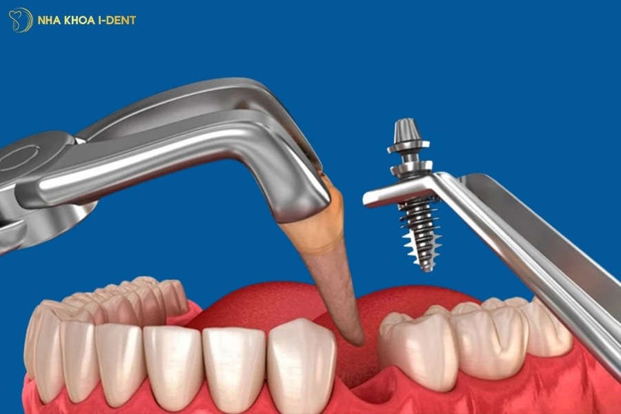 Răng bị sâu phải chữa trị làm sao