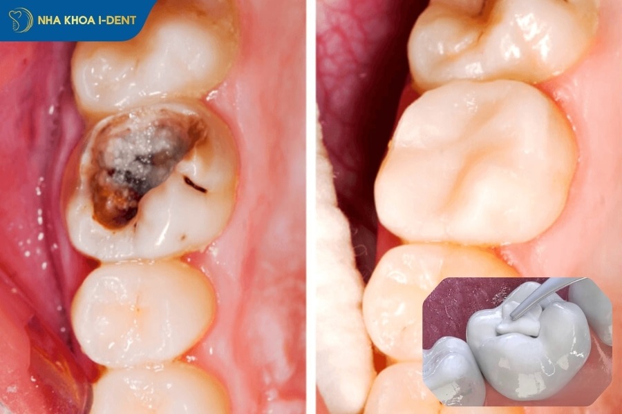Răng bị sâu phải làm sao khỏi