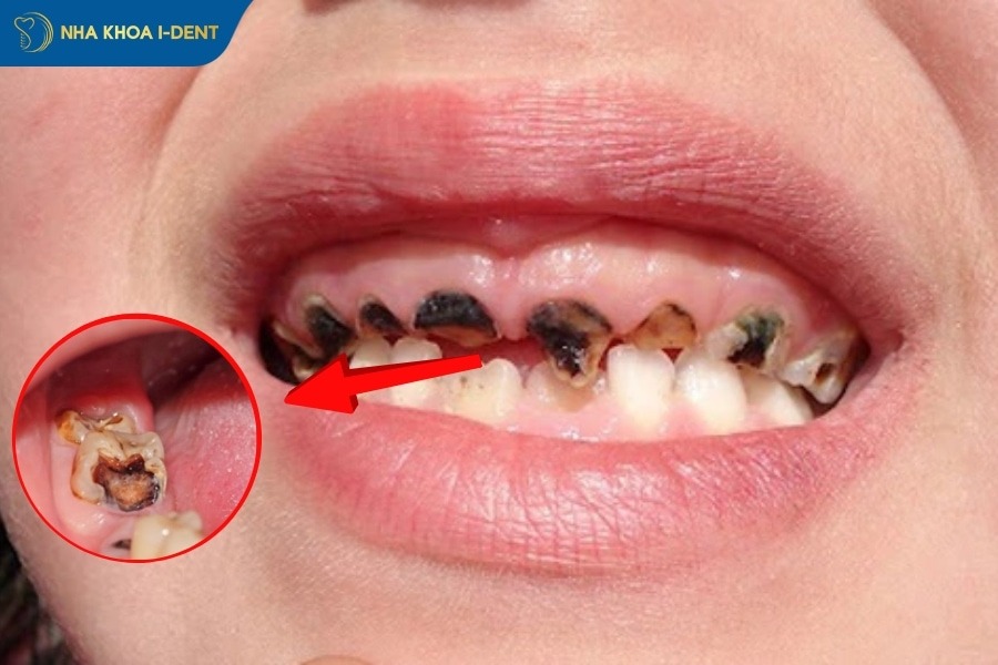 răng bị sâu phải làm sao