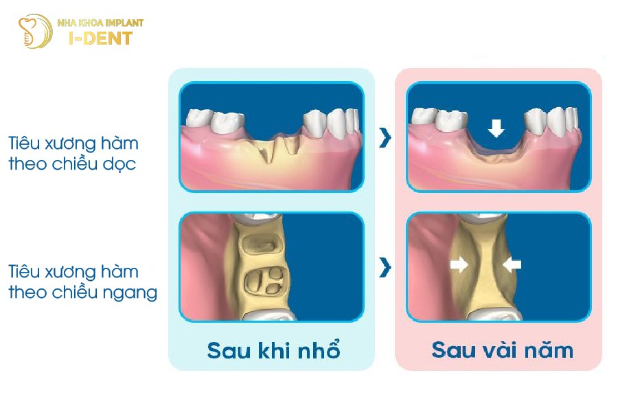 bệnh tiêu xương là gì