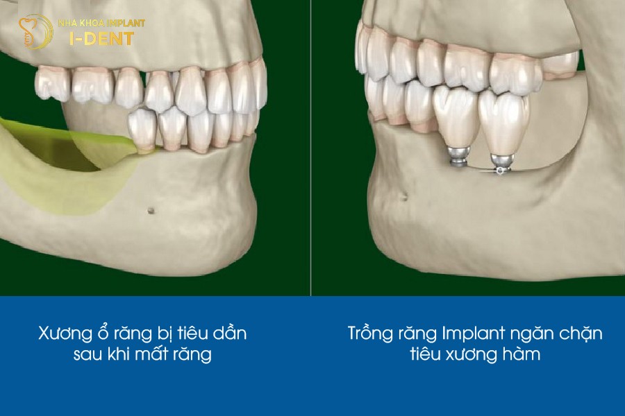 Tiêu xương răng