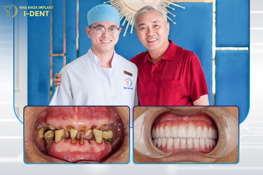 Chú Nguyễn Hải - Cấy ghép Implant 2 hàm All-on-4