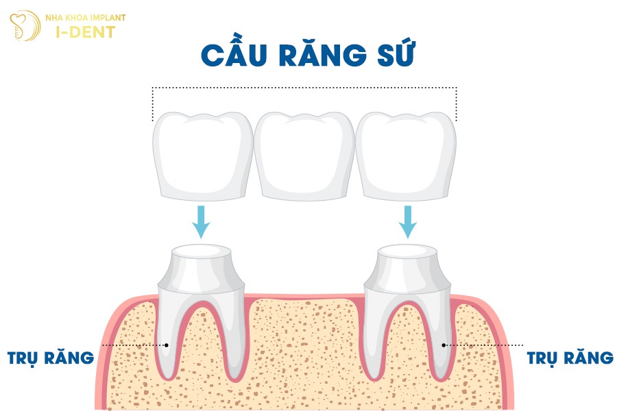 giá làm cầu răng sứ