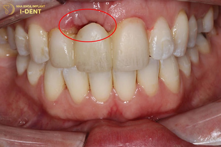 làm cầu răng sứ bao nhiêu tiền