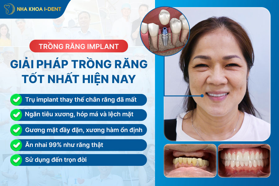 trồng 3 răng liên tiếp - Nha khoa I-Dent