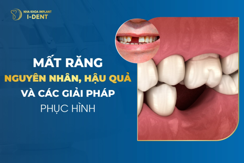 Mất răng hàm có sao không? Hậu quả mất răng