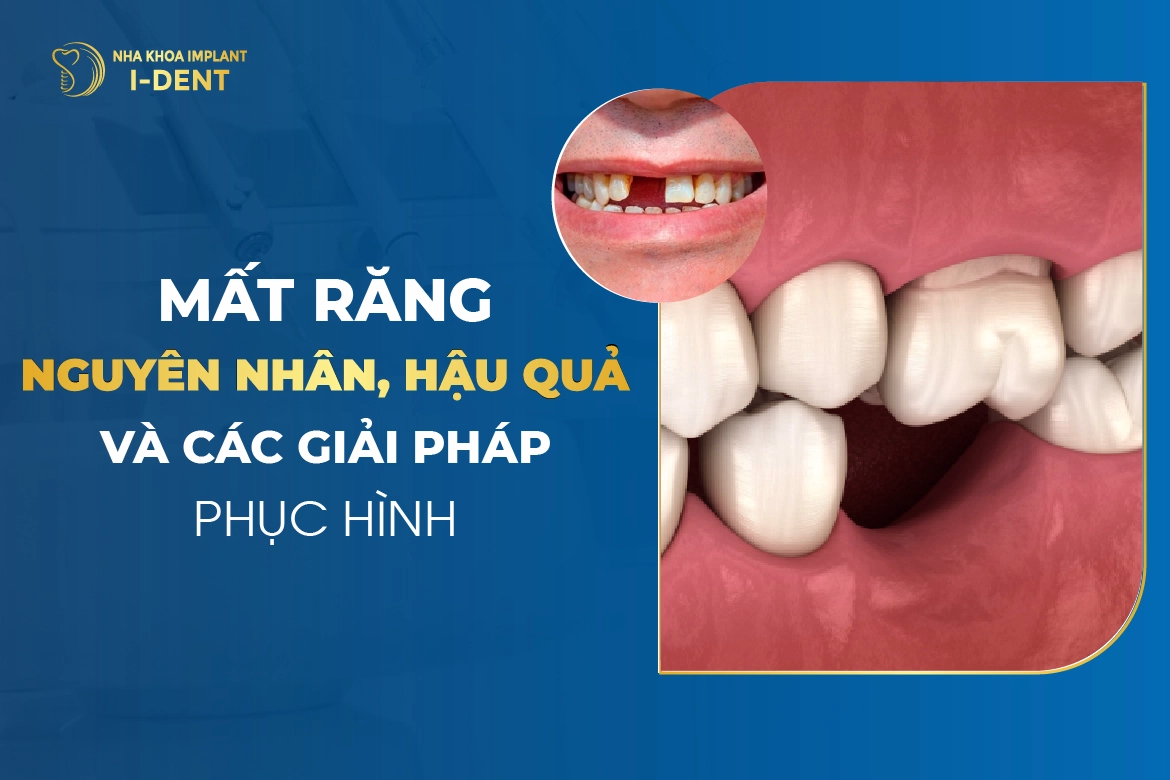 Mất răng: Nguyên nhân, hậu quả và các giải pháp phục hình