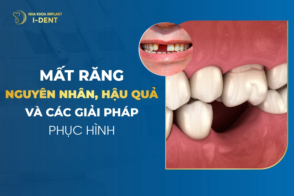 Mất Răng: Nguyên Nhân, Hậu Quả Và Các Giải Pháp Phục Hình