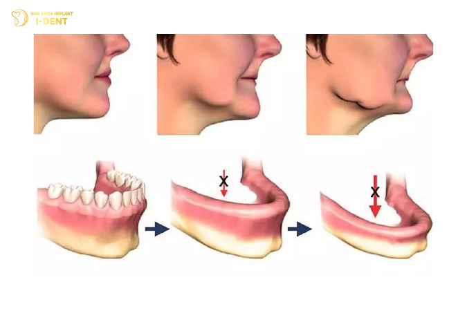 Mất răng toàn hàm khiến xương hàm bị tiêu và gương mặt già đi nhanh chóng