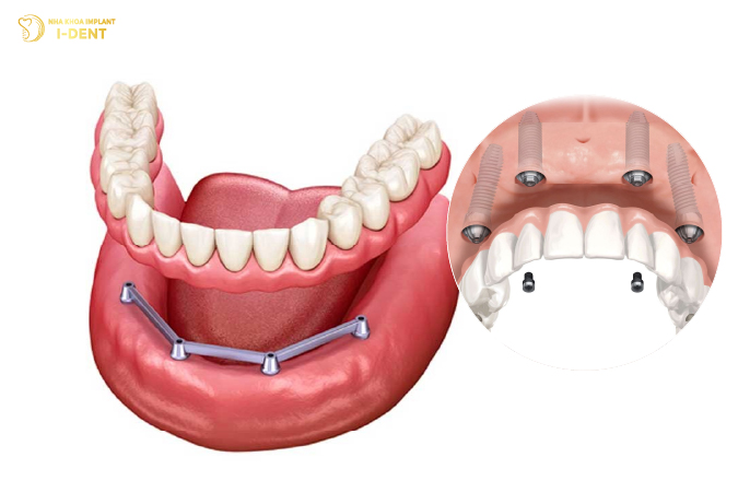 Phương pháp làm hàm phủ trên Implant