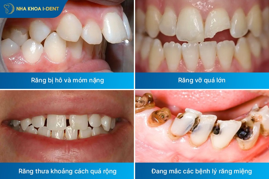 bọc răng không mài