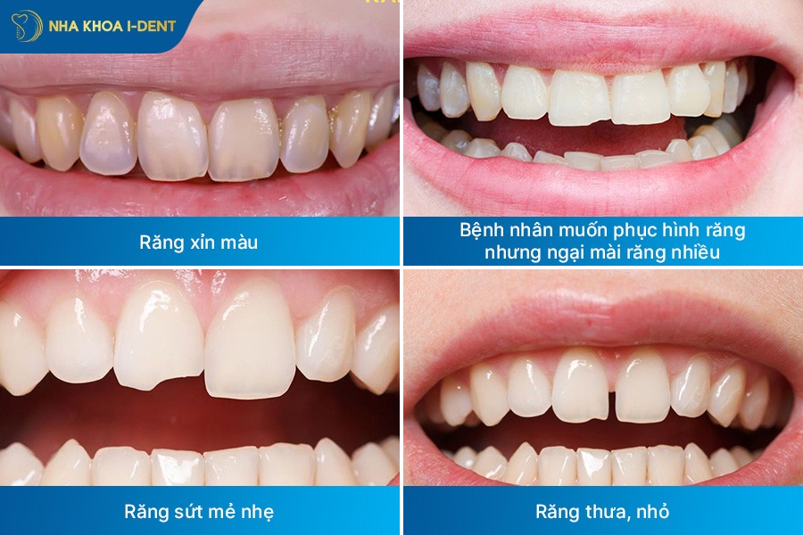 bọc răng sứ không cần mài
