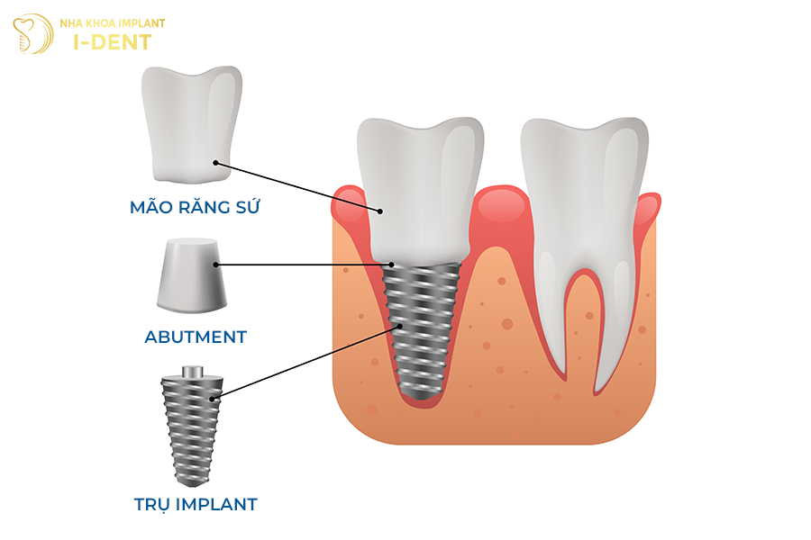 cấu tạo implant