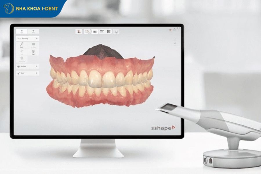 lấy dấu implant scan răng