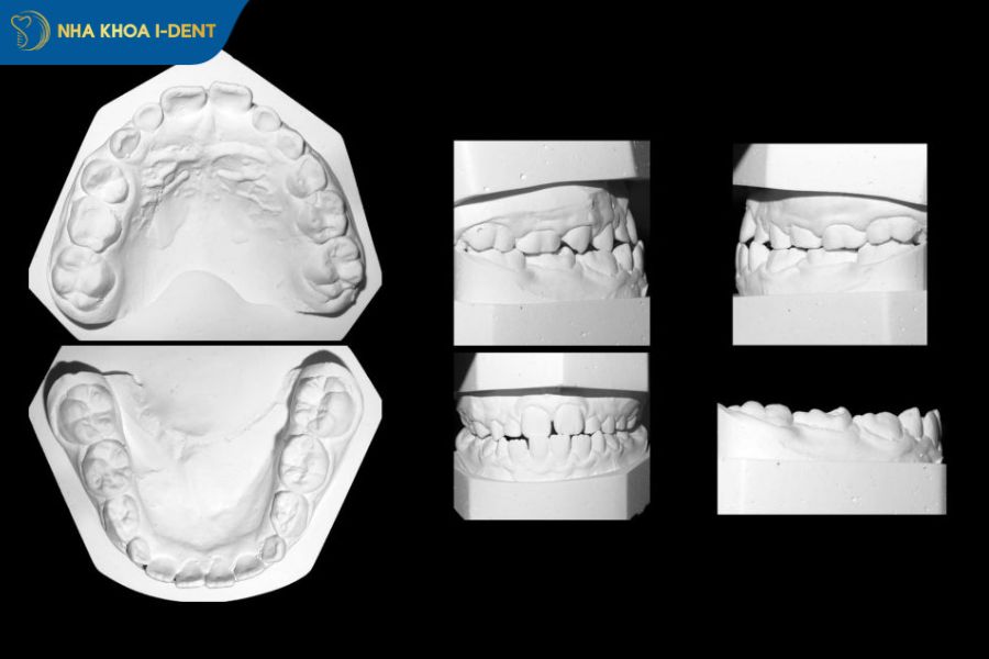 lấy dấu implant thạch cao