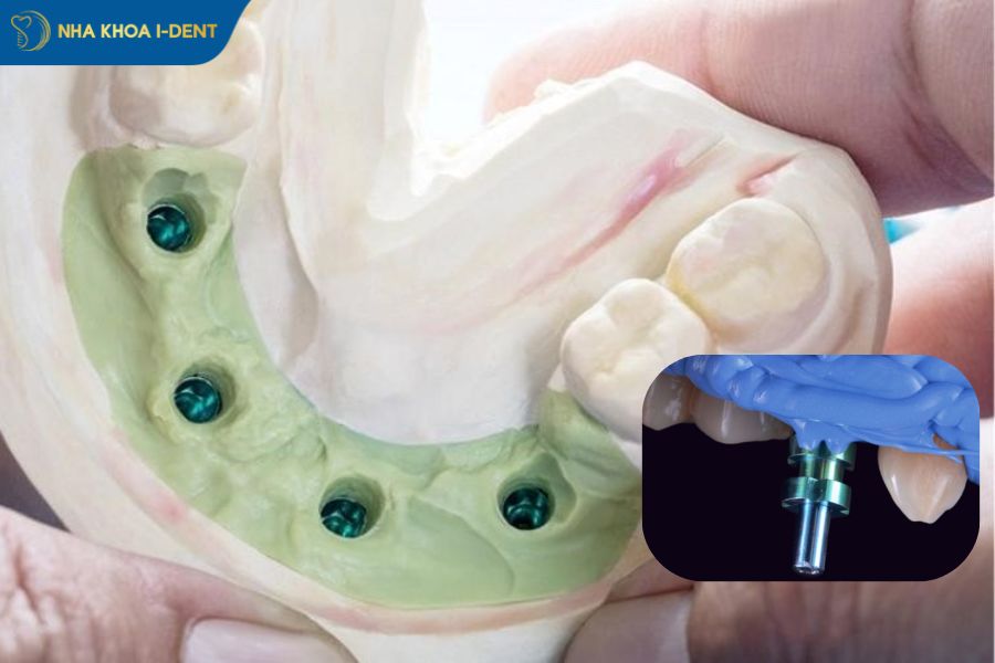 lấy dấu implant