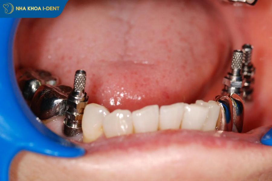 lấy dấu trụ implant