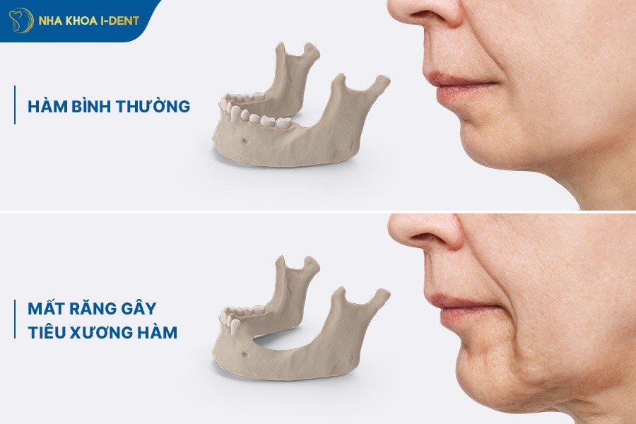mất răng không trồng lại có sao không