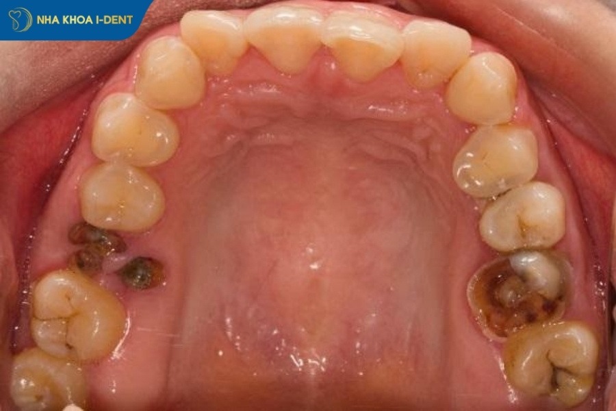 nhổ răng bao nhiêu tiền