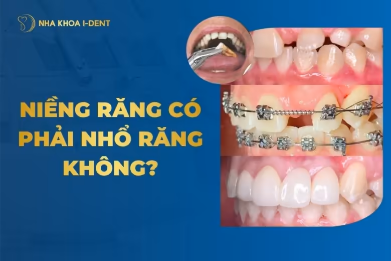 niềng răng có phải nhổ răng không