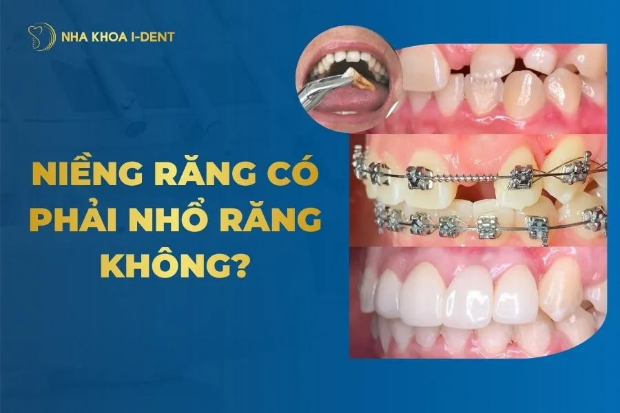 niềng răng có phải nhổ răng không