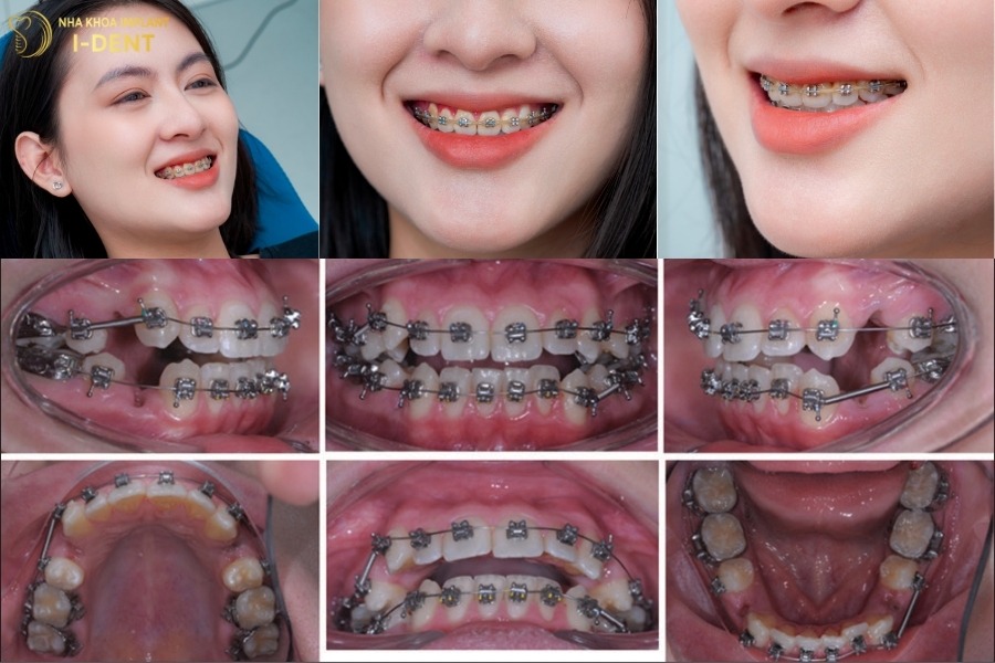 niềng răng nhổ răng nào