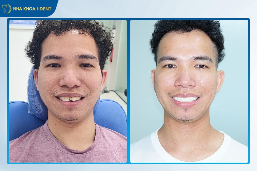 răng gãy ngang phải làm sao