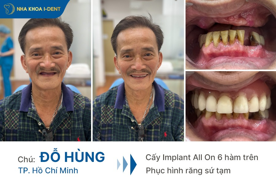 review trồng răng implant