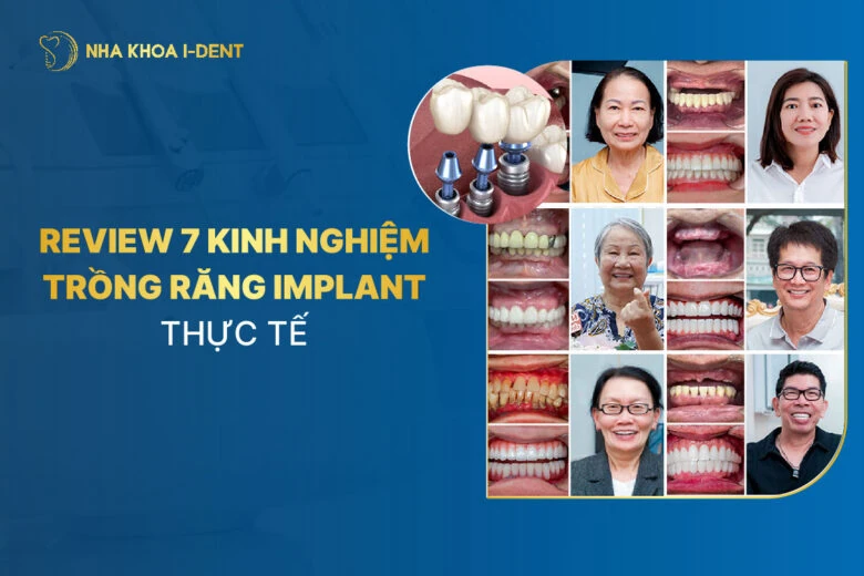 Review trồng răng implant: 7 Kinh nghiệm thực tế và giá