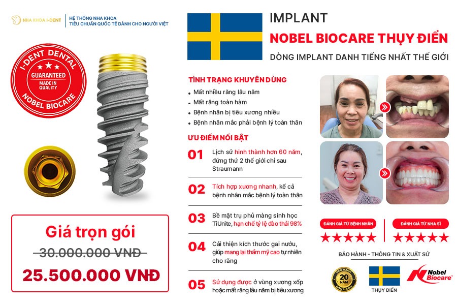 so sánh các loại trụ implant