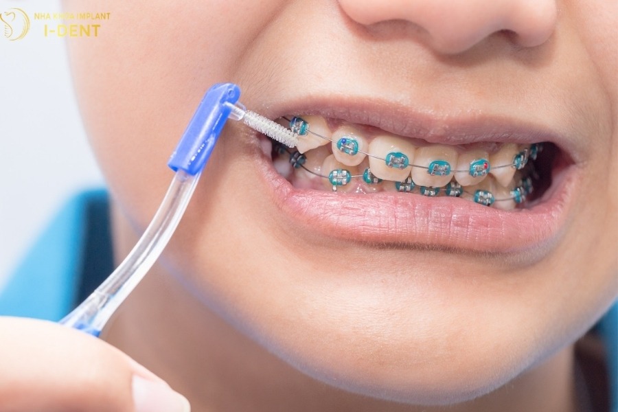 trong các giao đoạn niềng răng