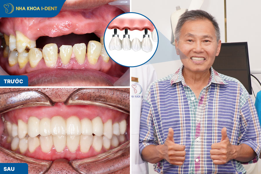 trồng răng là gì - Nha khoa I-Dent