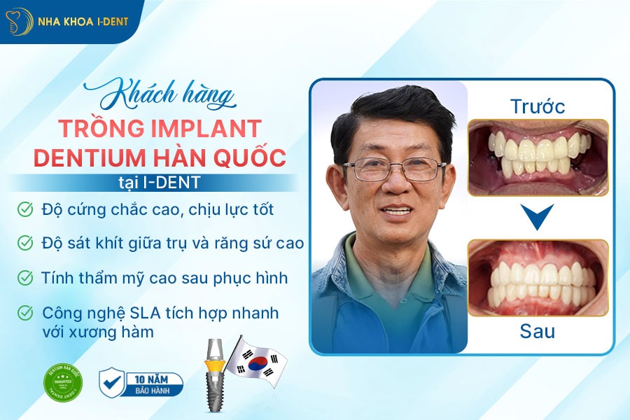 trụ implant hiossen mỹ;