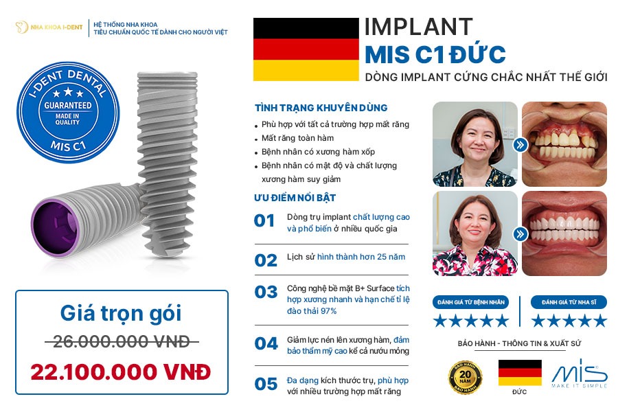 Trụ răng implant