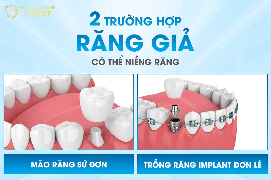 Trường hợp có thể niềng răng giả.