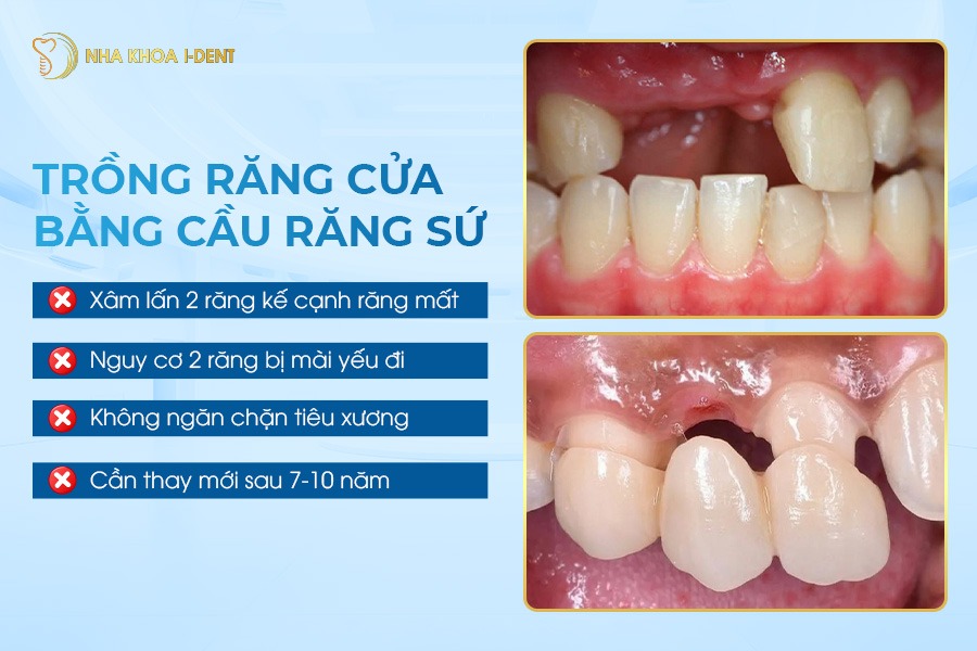 giá trồng răng cửa