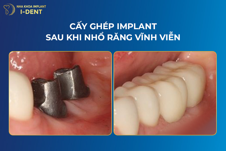 Cay-ghep-implant-sau-khi-nho-rang-vinh-vien