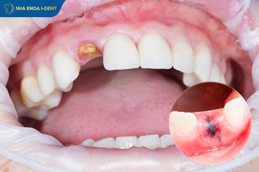 gãy răng hàm có sao không