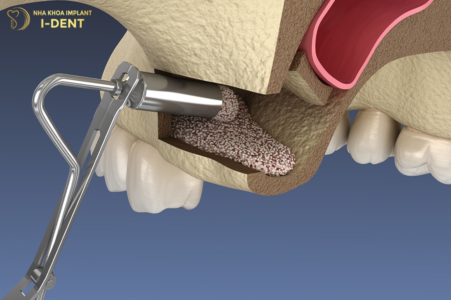 hối hận khi cấy implant