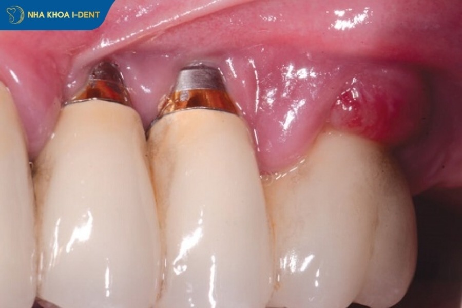 hối hận khi trồng implant