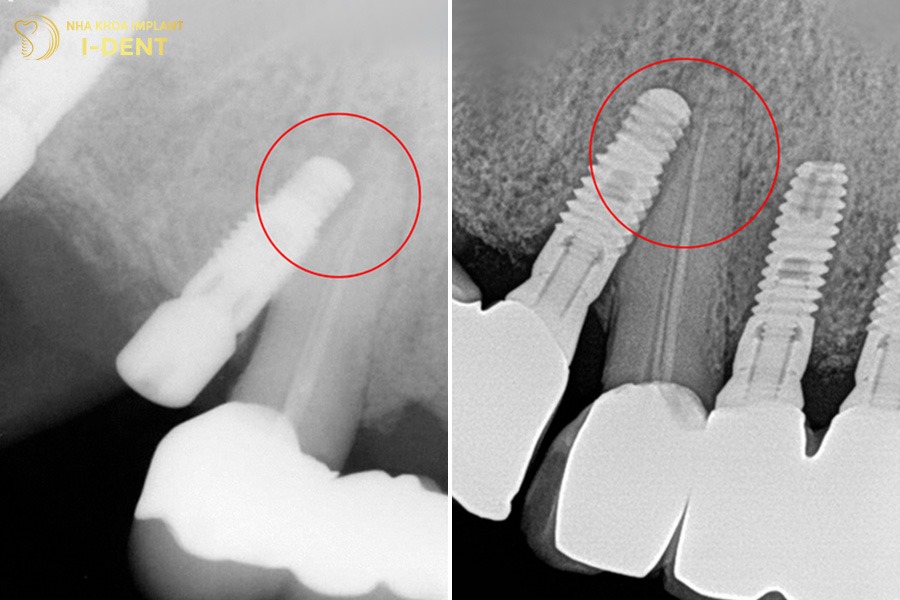 hối hận trồng răng implant