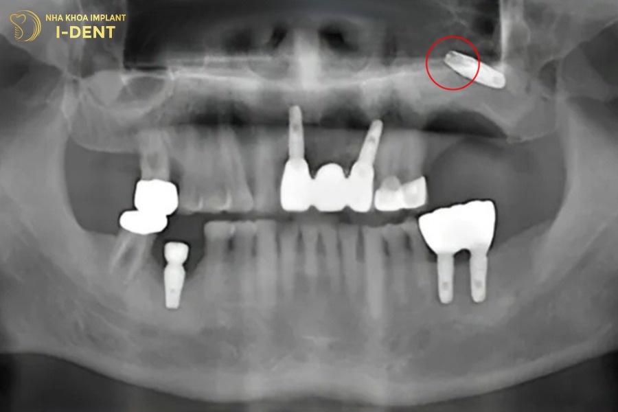hối hận khi trồng răng implant quá trễ