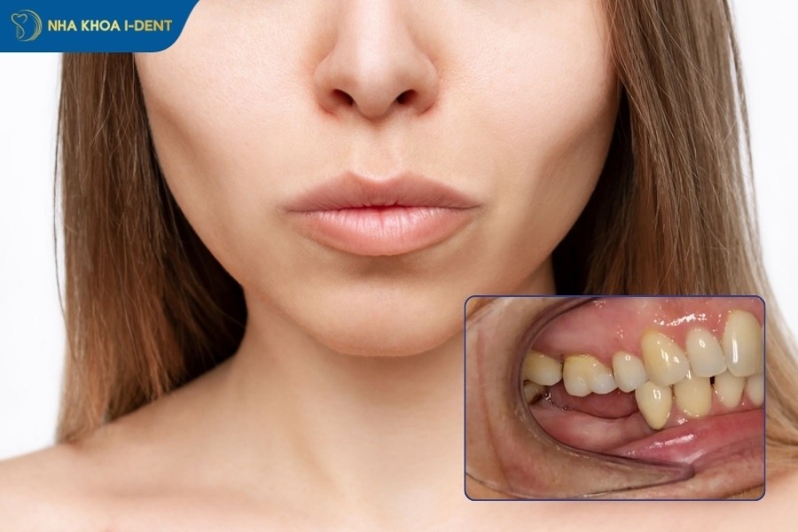 hối hận trồng răng implant