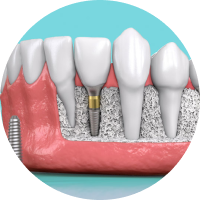 CHỌN TRỤ IMPLANT PHÙ HỢP VỚI TÀI CHÍNH