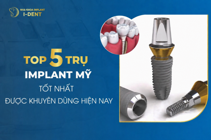 Top 4+ Trụ Implant Mỹ tốt nhất được khuyên dùng hiện nay